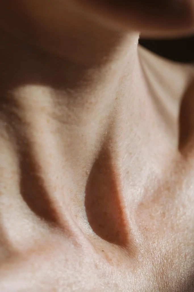 Microdermal piercing scar 