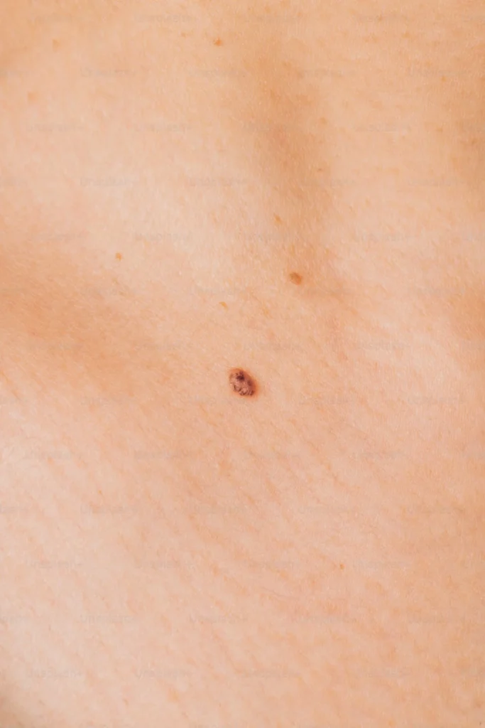 Microdermal piercing scar 