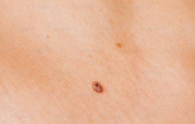 Microdermal piercing scar